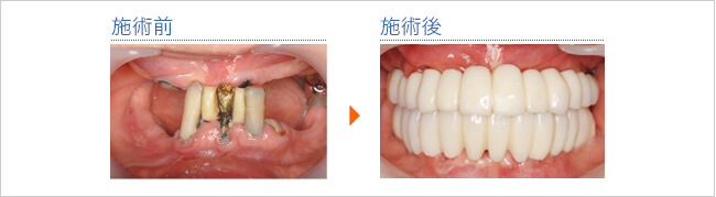 ケース1：多数歯欠損の症例写真