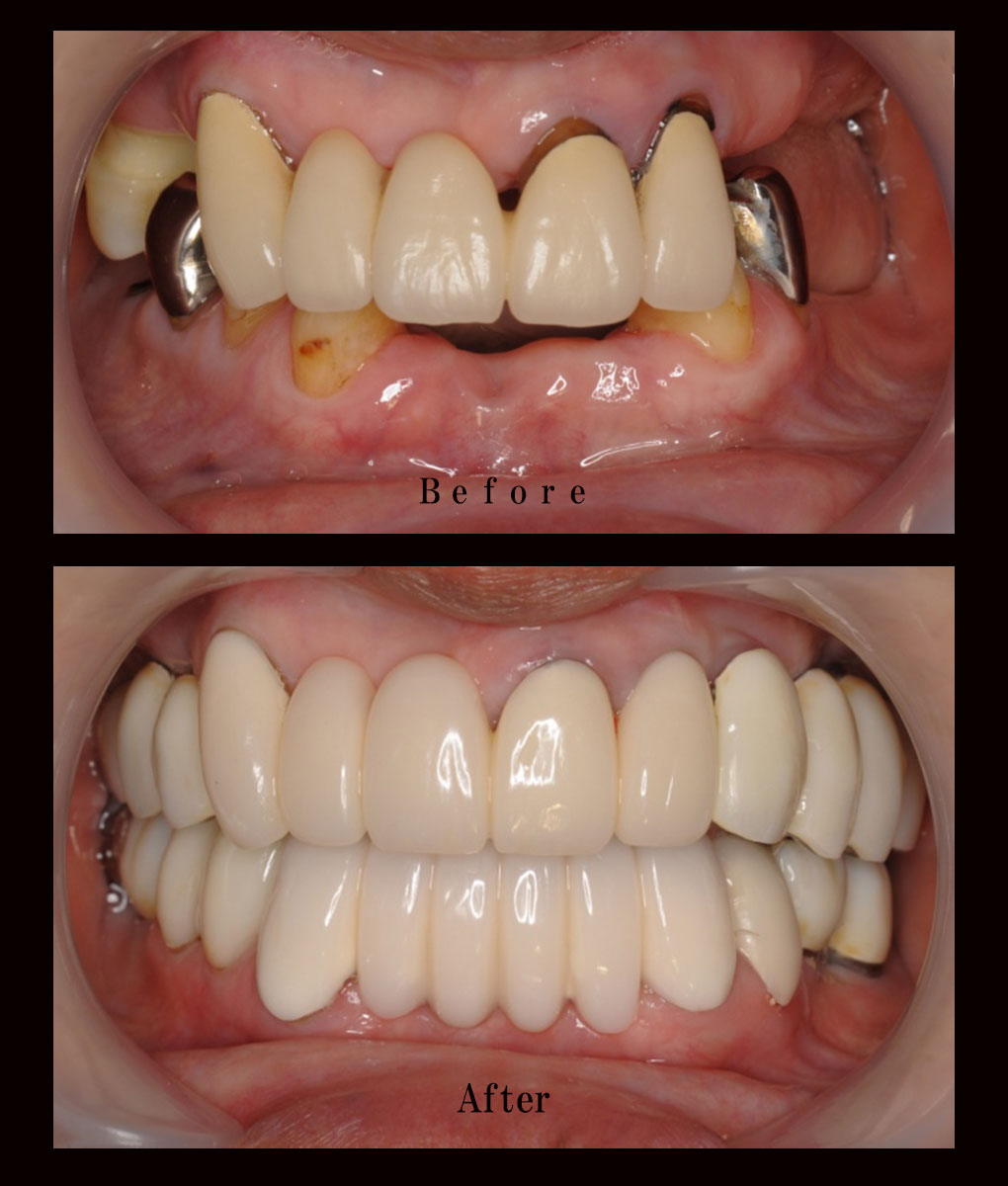 多数歯欠損ケース11の正面比較の写真