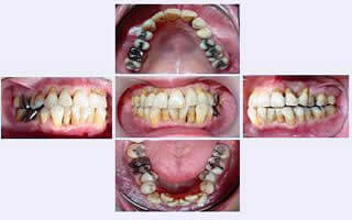 中等度以上の歯周病のインプラント治療症例1｜術前の写真