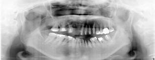 中等度以上の歯周病のインプラント治療症例1｜術前のレントゲン写真