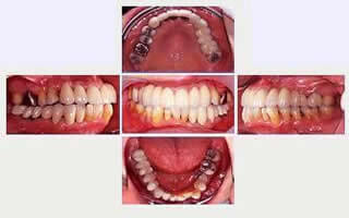 中等度以上の歯周病のインプラント治療症例1｜術後の写真