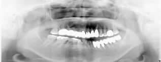 中等度以上の歯周病のインプラント治療症例1｜術後のレントゲン写真