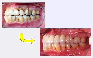 中等度以上の歯周病のインプラント治療症例1｜左側面の写真
