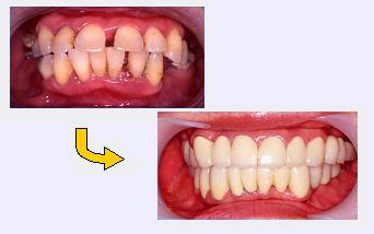 中等度以上の歯周病のインプラント治療症例2｜前面比較の写真