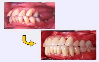 中等度以上の歯周病のインプラント治療症例1｜左側面比較の写真