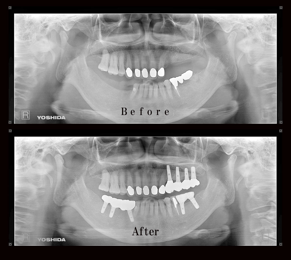 多数歯欠損ケース10のレントゲン比較の写真
