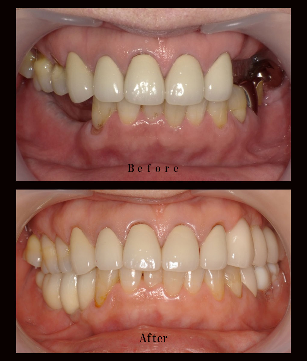 多数歯欠損ケース10の正面比較の写真
