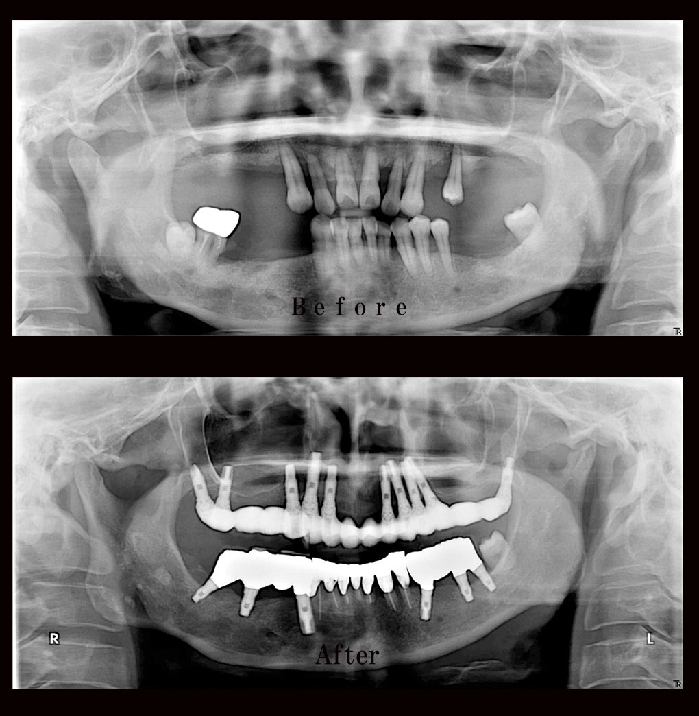 多数歯欠損ケース2のレントゲン比較の写真
