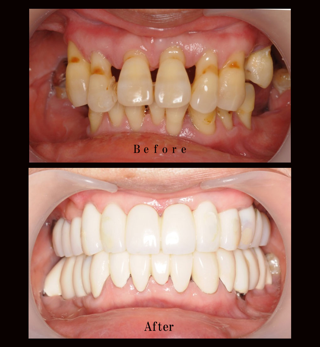 多数歯欠損ケース2の正面比較の写真