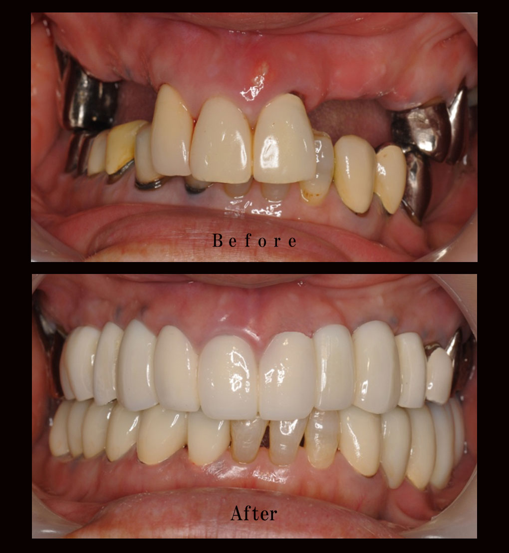 多数歯欠損ケース3の正面比較の写真