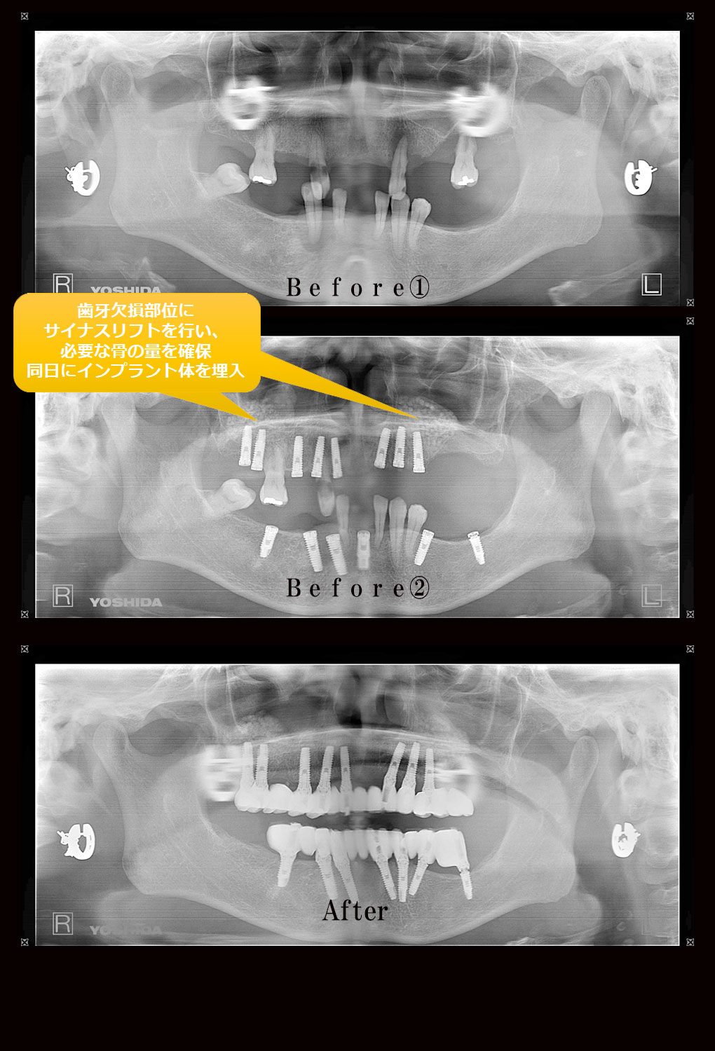 多数歯欠損ケース4のレントゲン比較の写真