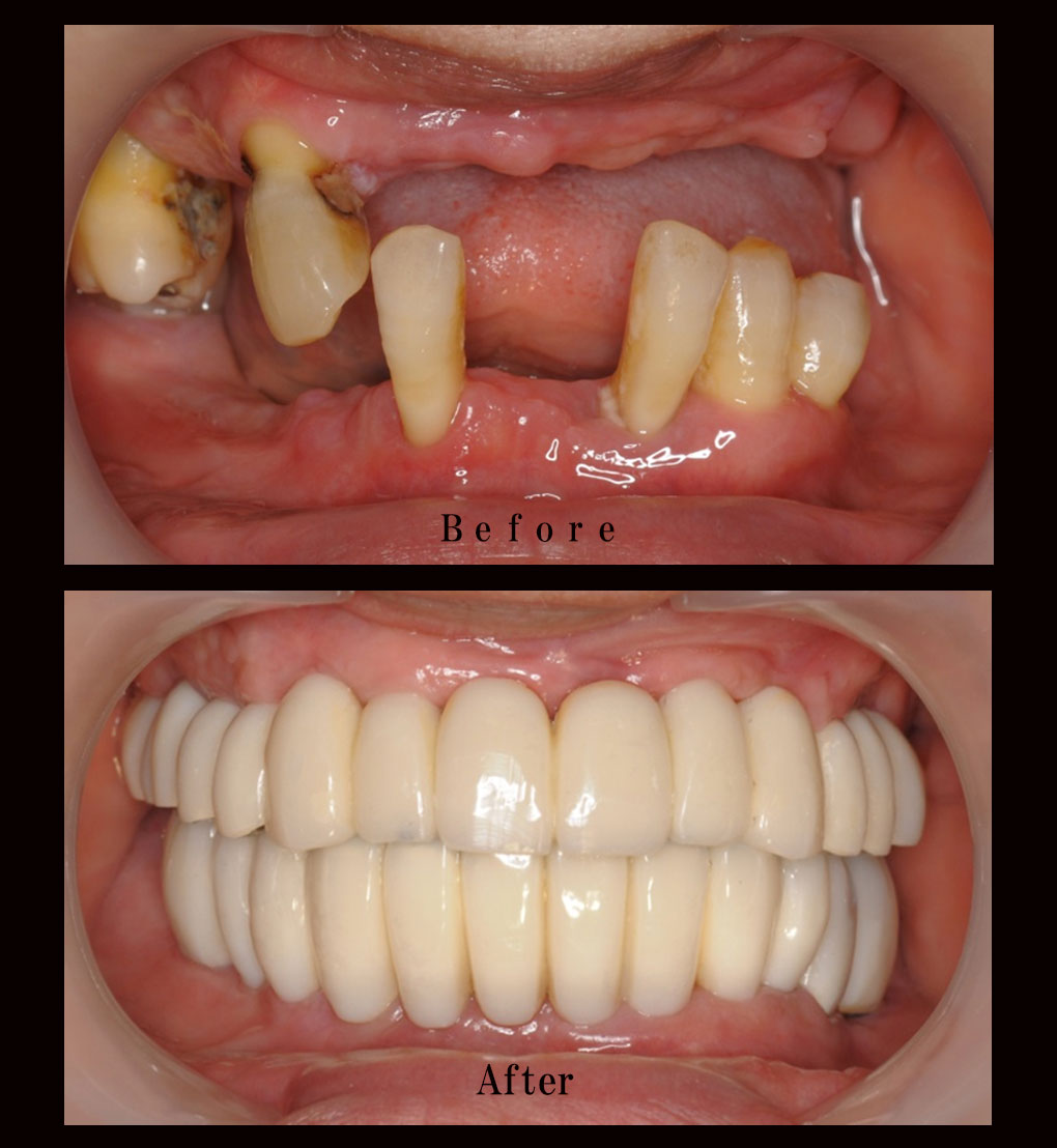 多数歯欠損ケース4の正面比較の写真