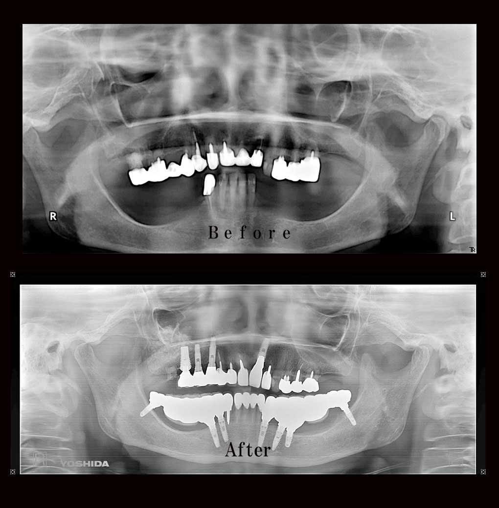 多数歯欠損ケース5のレントゲン比較の写真