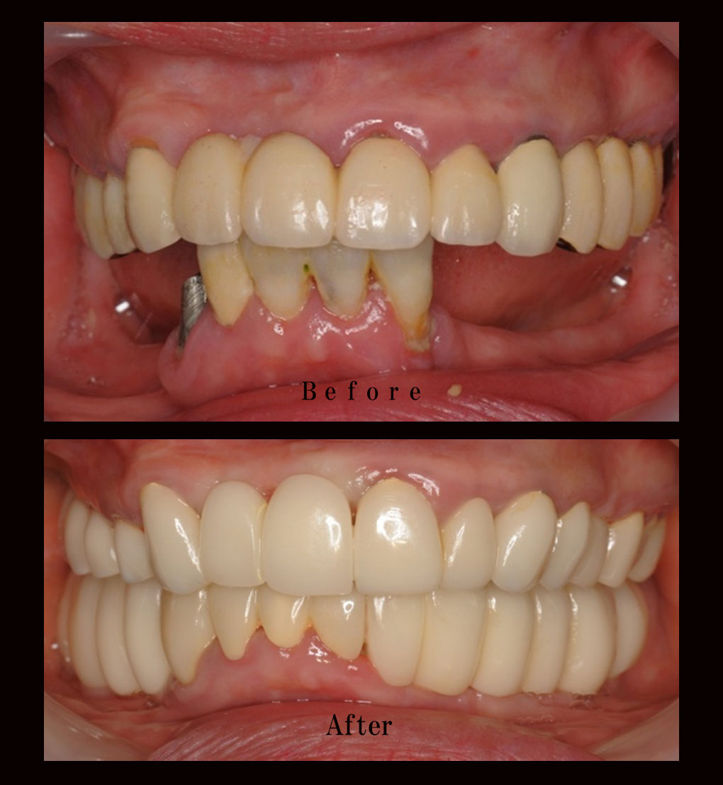 多数歯欠損ケース7の正面比較の写真