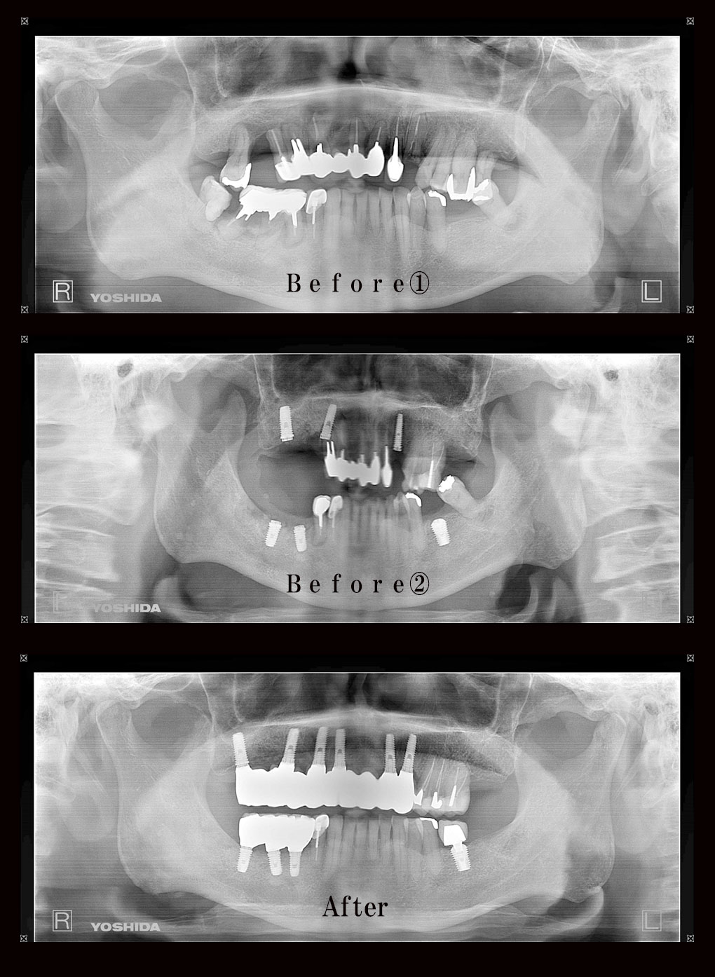 多数歯欠損ケース8のレントゲン比較の写真