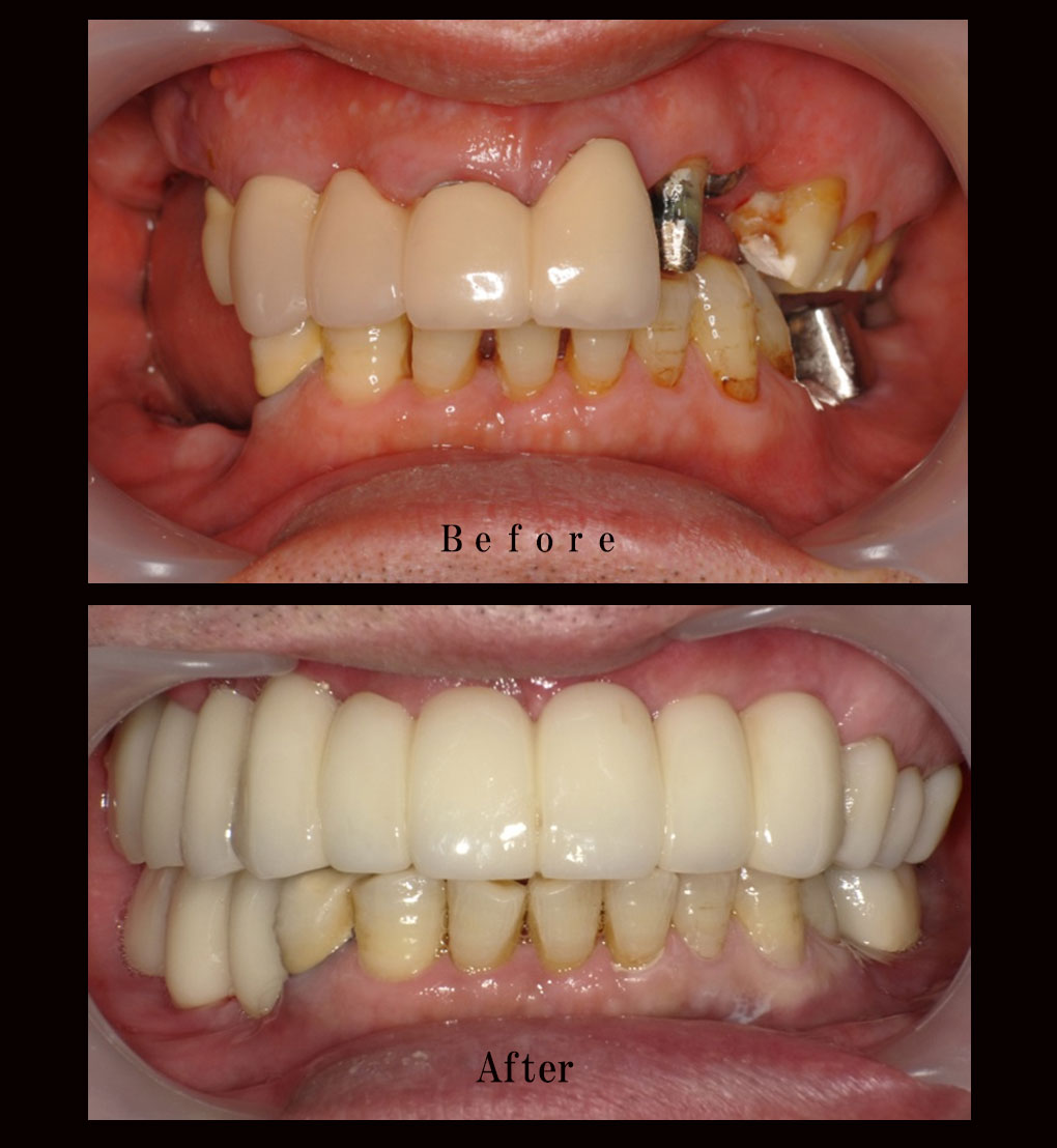 多数歯欠損ケース8の正面比較の写真