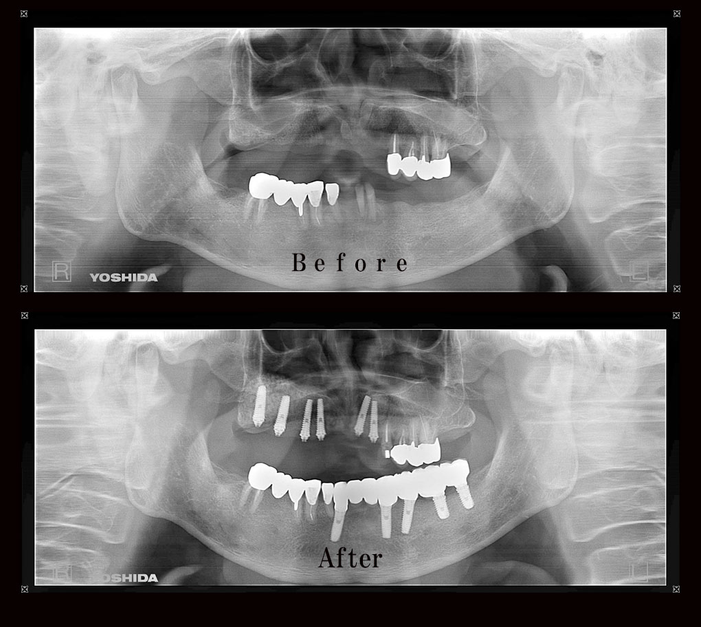 多数歯欠損ケース9のレントゲン比較の写真